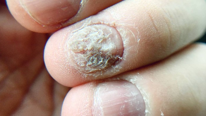 fungal nail infection_summary.jpg