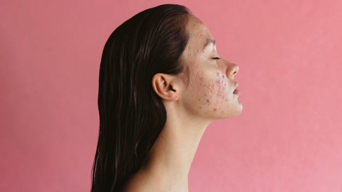 woman with acne.jpg