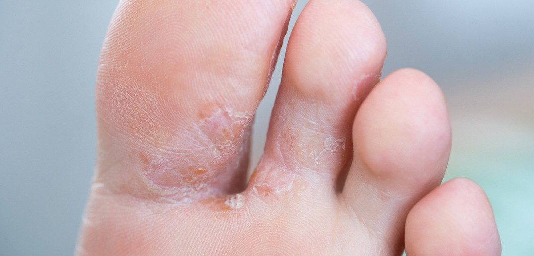 Fungal foot infection.jpg